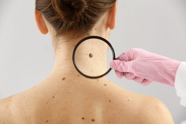  despistaje de cáncer de piel