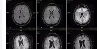 Cerebro dañado