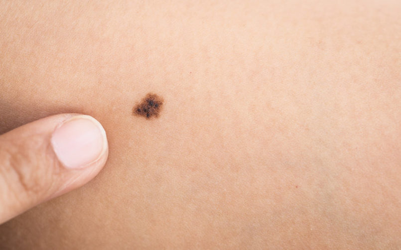 melanoma